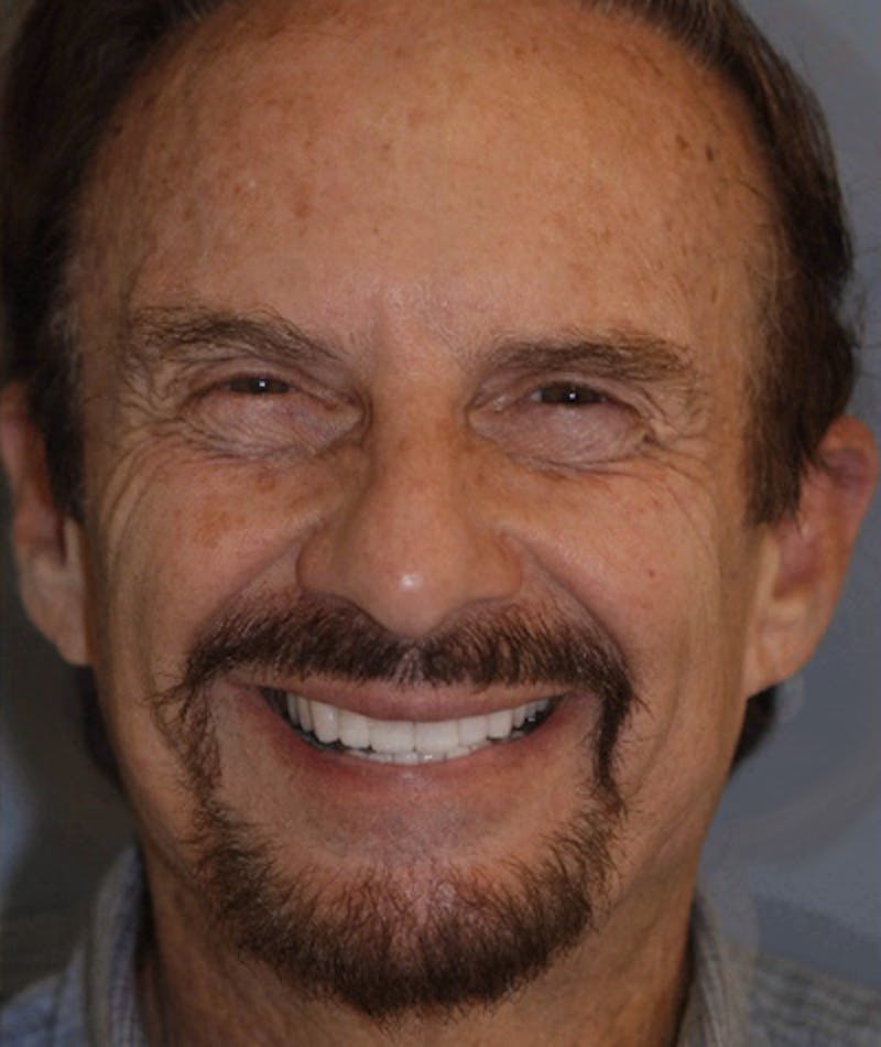 Anti Aging Before & After Gallery - Patient 237149 - Image 2