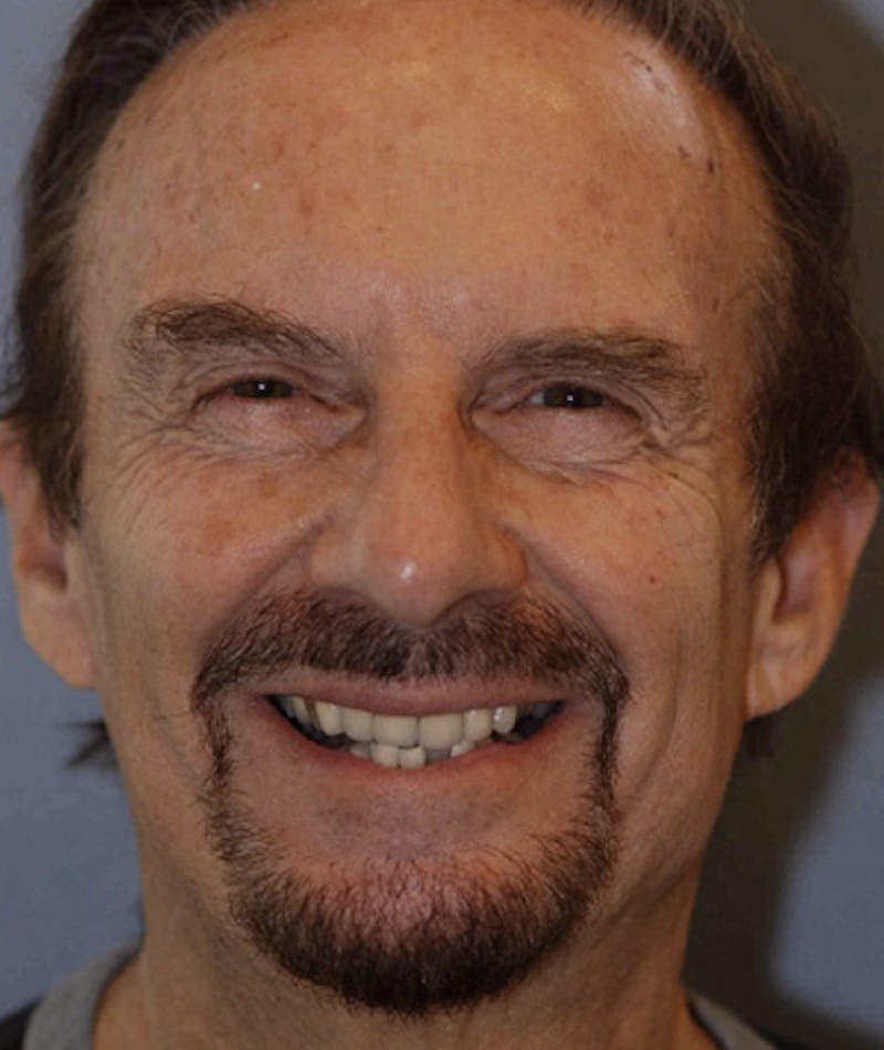 Anti Aging Before & After Gallery - Patient 237149 - Image 1