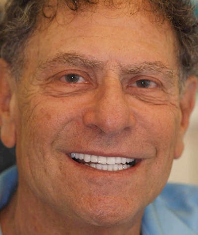 Anti Aging Before & After Gallery - Patient 175809 - Image 2