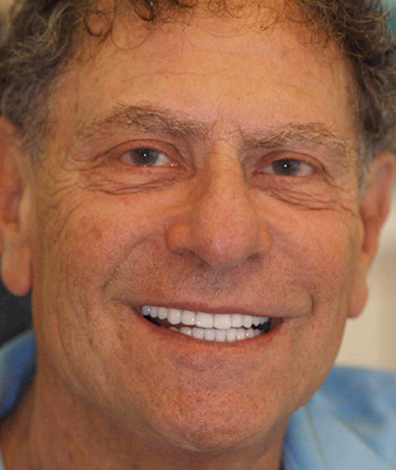 Anti Aging Before & After Gallery - Patient 175809 - Image 2