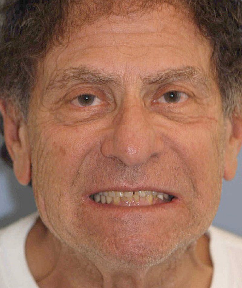 Anti Aging Before & After Gallery - Patient 175809 - Image 1
