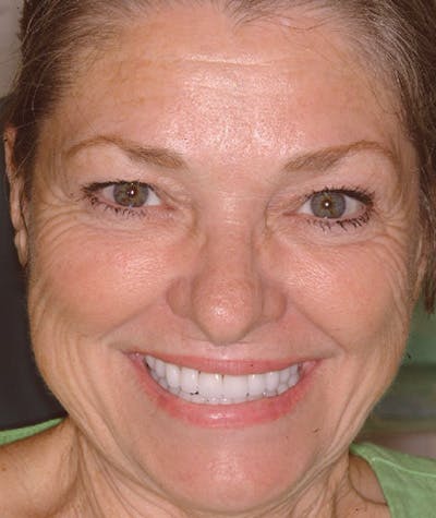 Anti Aging Before & After Gallery - Patient 150131 - Image 2