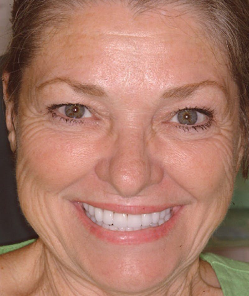 Anti Aging Before & After Gallery - Patient 150131 - Image 2