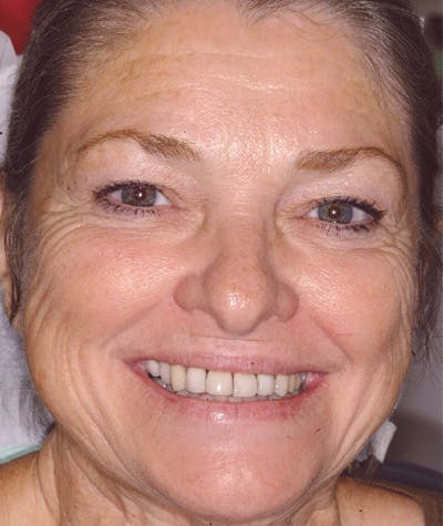 Anti Aging Before & After Gallery - Patient 150131 - Image 1