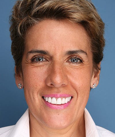 Anti Aging Before & After Gallery - Patient 119549 - Image 2