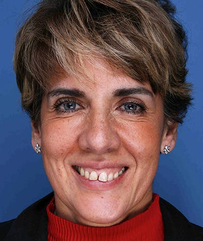 Anti Aging Before & After Gallery - Patient 119549 - Image 1