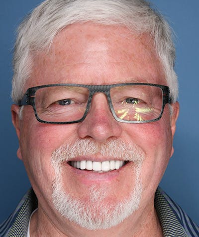 Anti Aging Before & After Gallery - Patient 396454 - Image 2