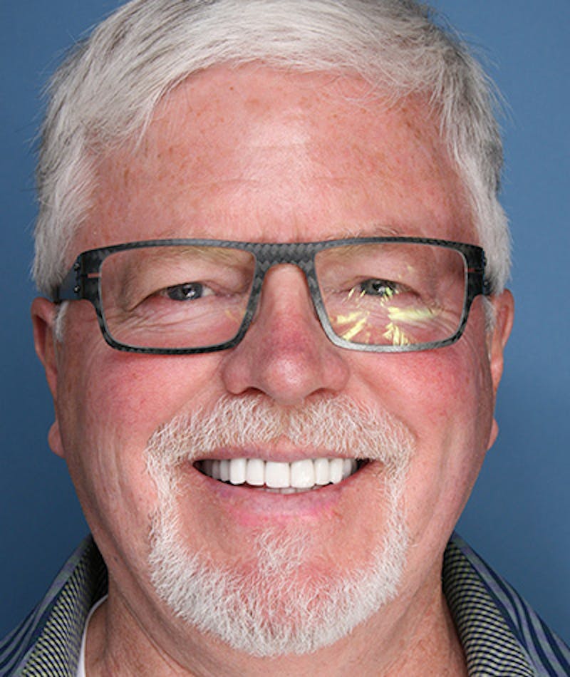 Anti Aging Before & After Gallery - Patient 396454 - Image 2