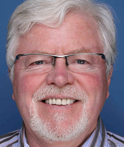 Anti Aging Before & After Gallery - Patient 396454 - Image 1