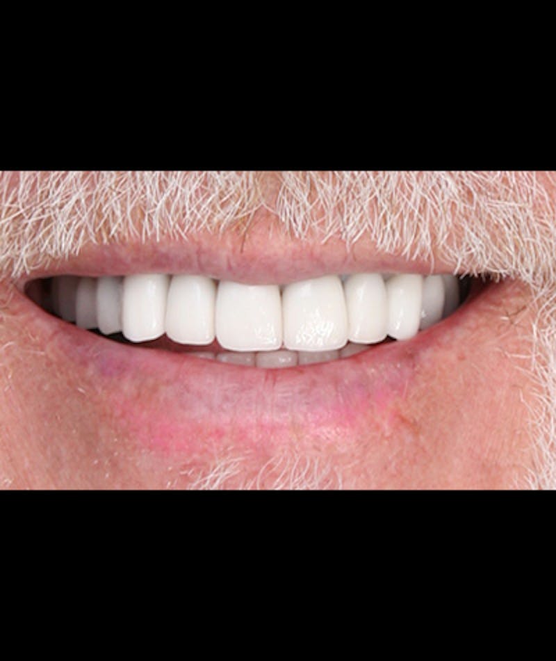 Anti Aging Before & After Gallery - Patient 396454 - Image 4