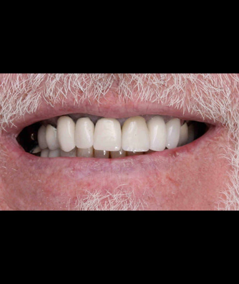 Anti Aging Before & After Gallery - Patient 396454 - Image 3