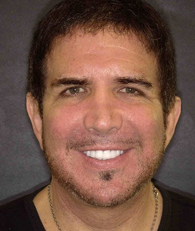 Anti Aging Before & After Gallery - Patient 369954 - Image 2