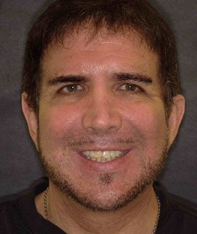 Anti Aging Before & After Gallery - Patient 369954 - Image 1