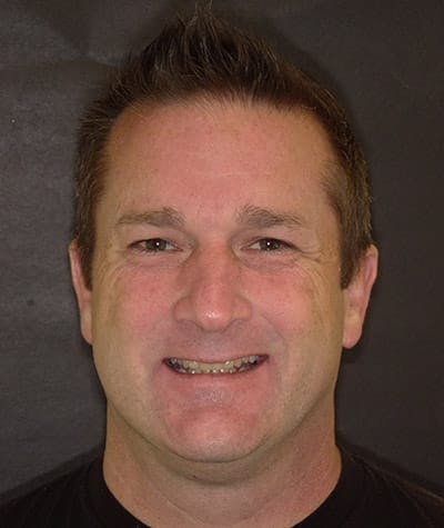 Anti Aging Before & After Gallery - Patient 275757 - Image 1