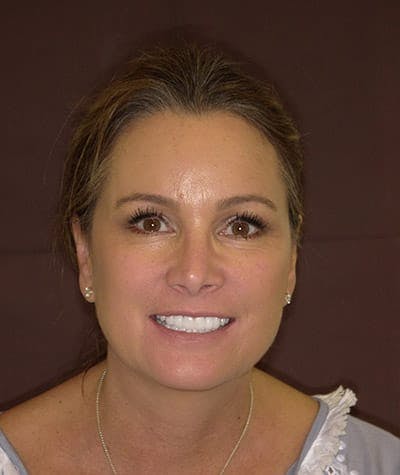 Anti Aging Before & After Gallery - Patient 382197 - Image 2