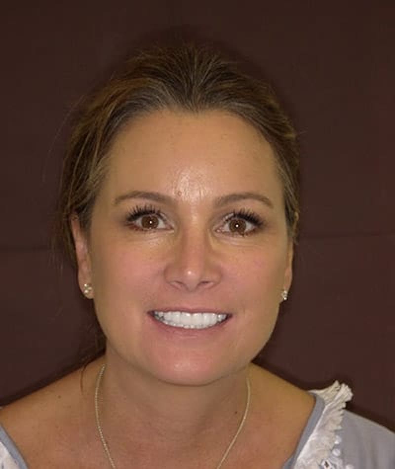 Anti Aging Before & After Gallery - Patient 382197 - Image 2