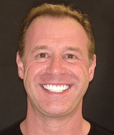 Anti Aging Before & After Gallery - Patient 106507 - Image 2