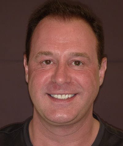 Anti Aging Before & After Gallery - Patient 106507 - Image 1