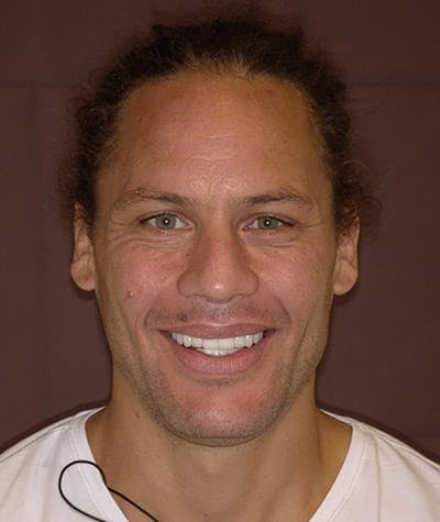 Anti Aging Before & After Gallery - Patient 160152 - Image 2