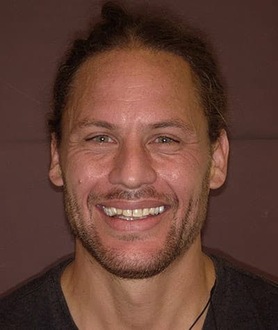 Anti Aging Before & After Gallery - Patient 160152 - Image 1