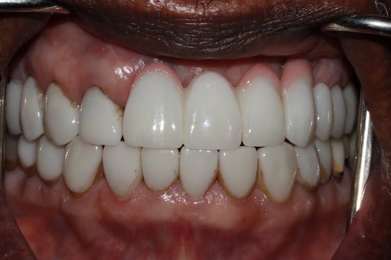 Veneers Before & After Gallery - Patient 370413 - Image 2