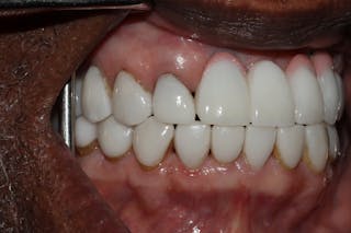 Veneers Before & After Gallery - Patient 370413 - Image 6