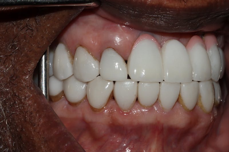 Veneers Before & After Gallery - Patient 370413 - Image 6