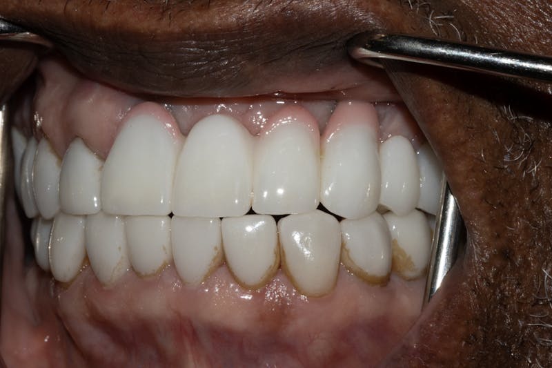 Veneers Before & After Gallery - Patient 370413 - Image 4