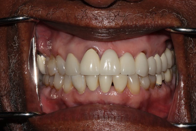 Veneers Before & After Gallery - Patient 370413 - Image 1