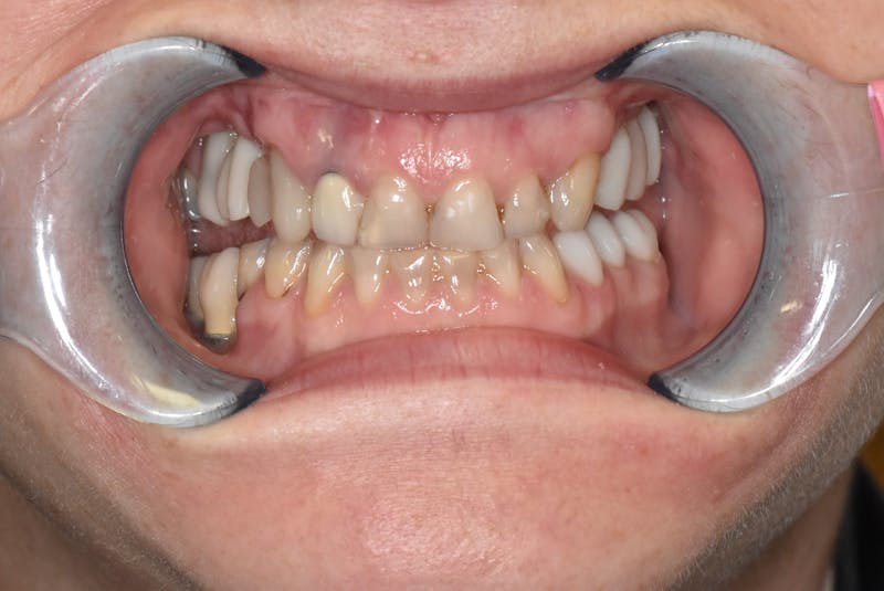 Other Procedures Before & After Gallery - Patient 365628 - Image 1