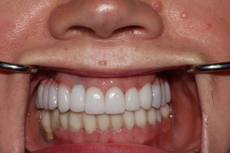 Other Procedures Before & After Gallery - Patient 365628 - Image 2