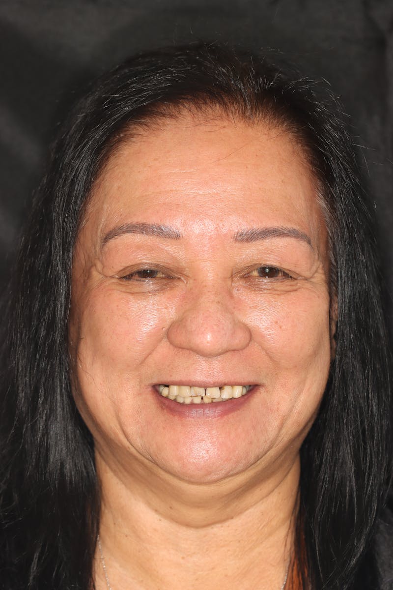 Other Procedures Before & After Gallery - Patient 310693 - Image 1