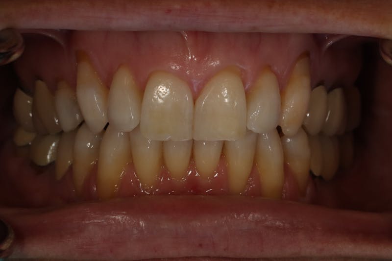 Other Procedures Before & After Gallery - Patient 297121 - Image 1