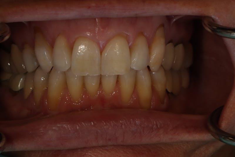 Other Procedures Before & After Gallery - Patient 297121 - Image 2