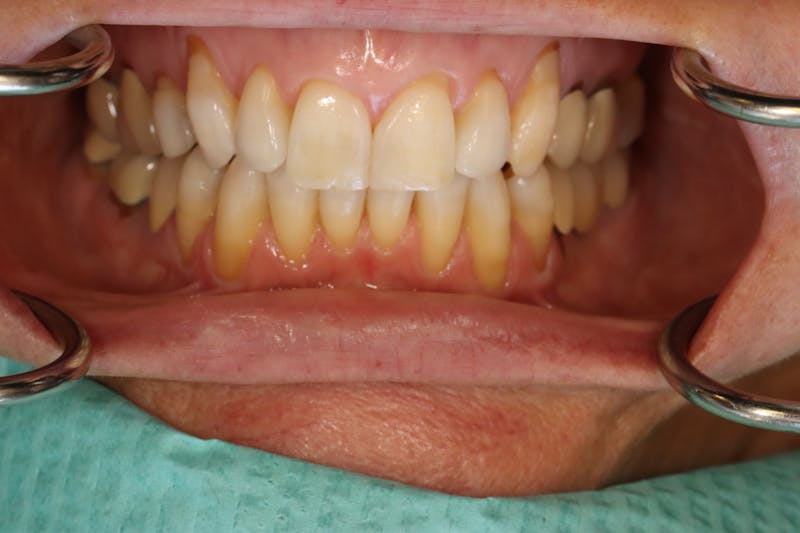 Other Procedures Before & After Gallery - Patient 297121 - Image 4