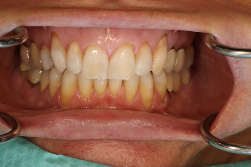 Other Procedures Before & After Gallery - Patient 297121 - Image 5