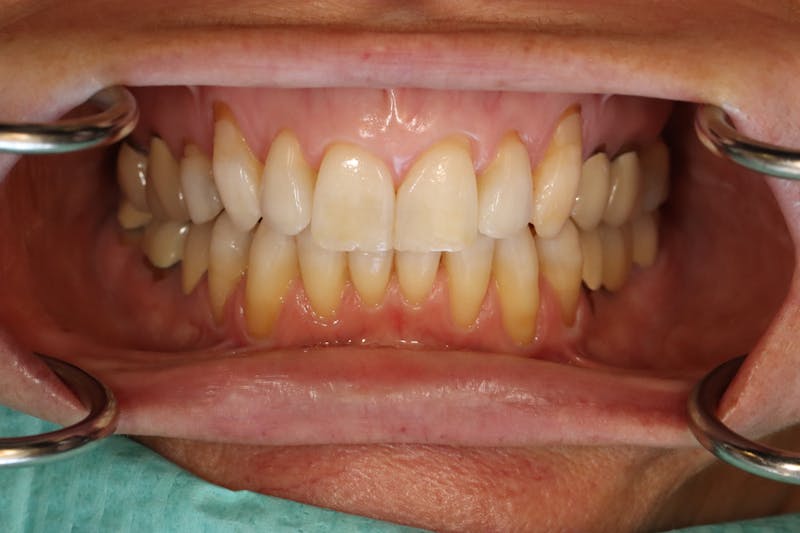 Other Procedures Before & After Gallery - Patient 297121 - Image 6