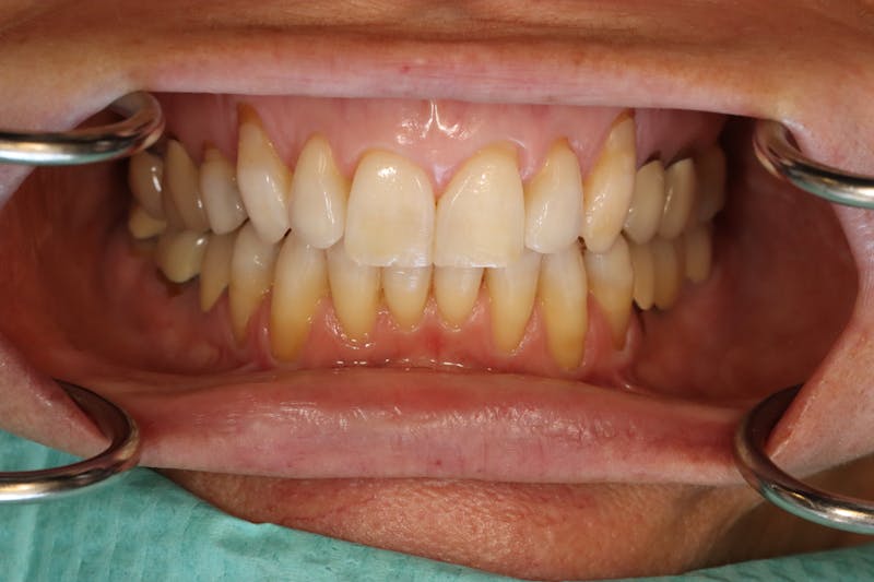 Other Procedures Before & After Gallery - Patient 297121 - Image 7