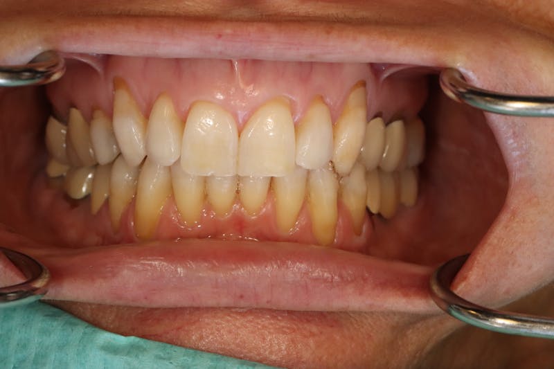 Other Procedures Before & After Gallery - Patient 297121 - Image 8