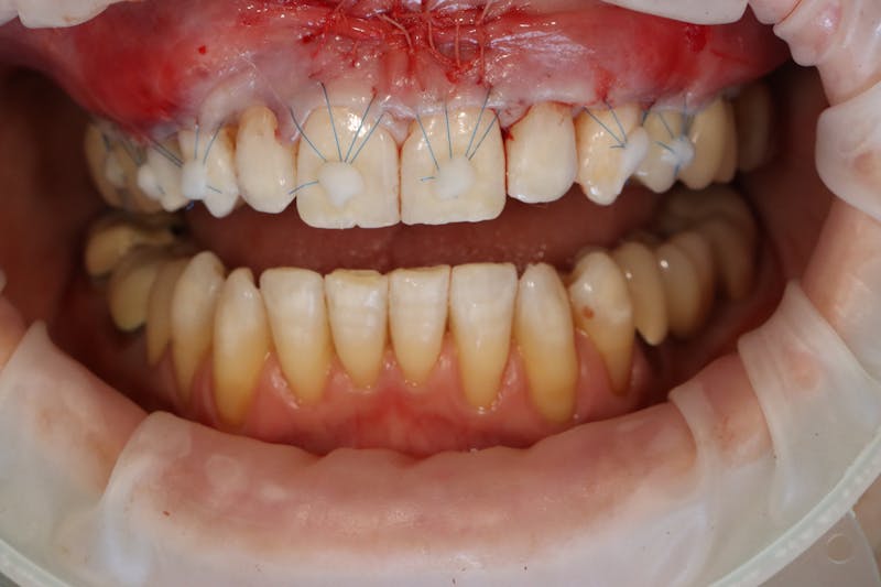 Other Procedures Before & After Gallery - Patient 297121 - Image 9