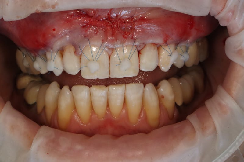 Other Procedures Before & After Gallery - Patient 297121 - Image 11