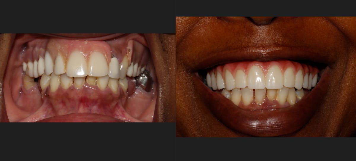 Other Procedures Before & After Gallery - Patient 380140 - Image 1