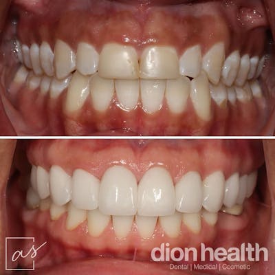 Smile Makeover Before & After Gallery - Patient 358203 - Image 1