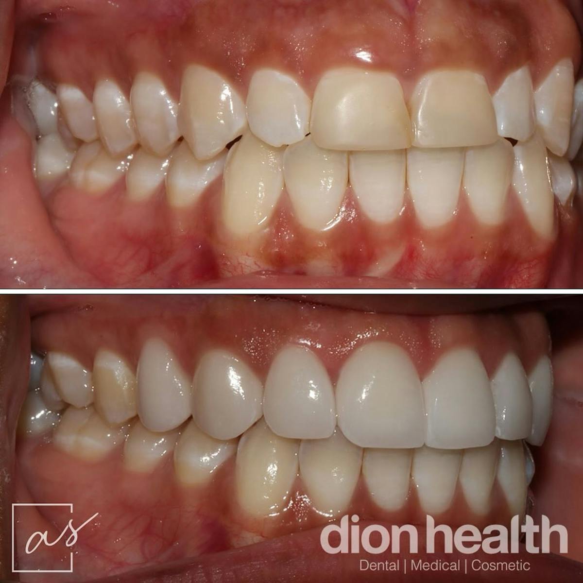 Smile Makeover Before & After Gallery - Patient 358203 - Image 2