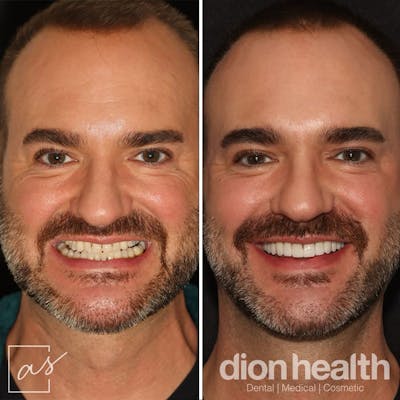 Anti Aging Before & After Gallery - Patient 412401 - Image 1