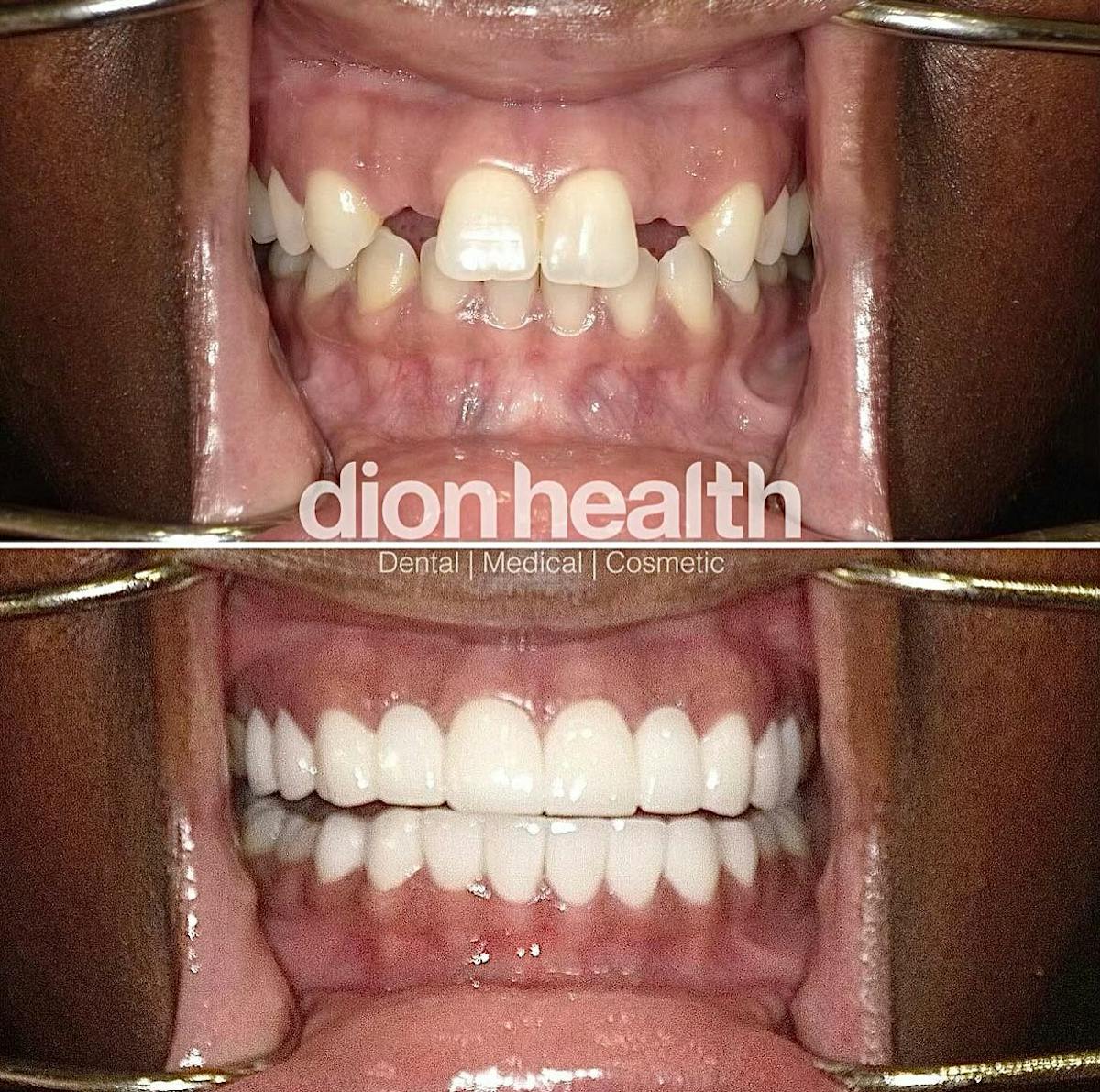 Smile Makeover Before & After Gallery - Patient 301937 - Image 1