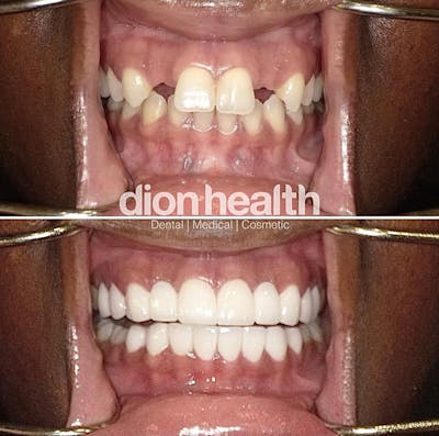 Smile Makeover Before & After Gallery - Patient 301937 - Image 1