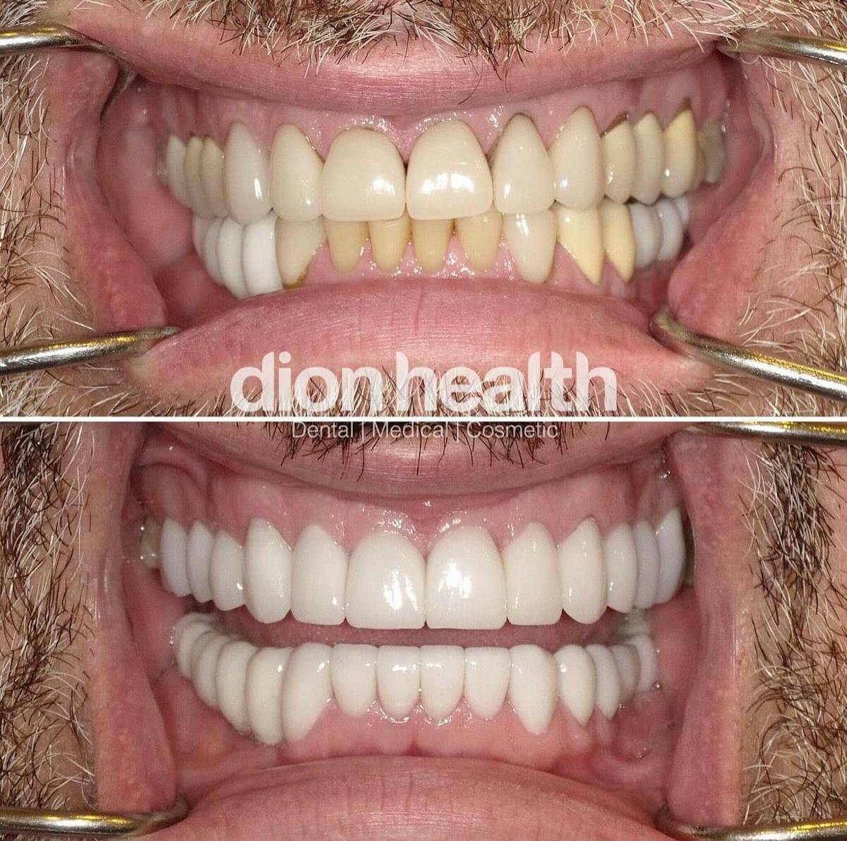 Veneers Before & After Gallery - Patient 142625 - Image 1