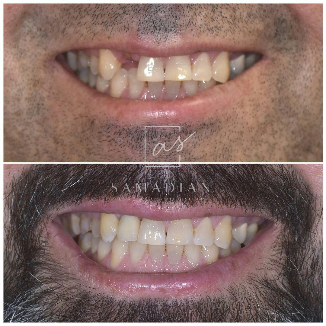 Dental Implants Before & After Gallery - Patient 254037 - Image 1