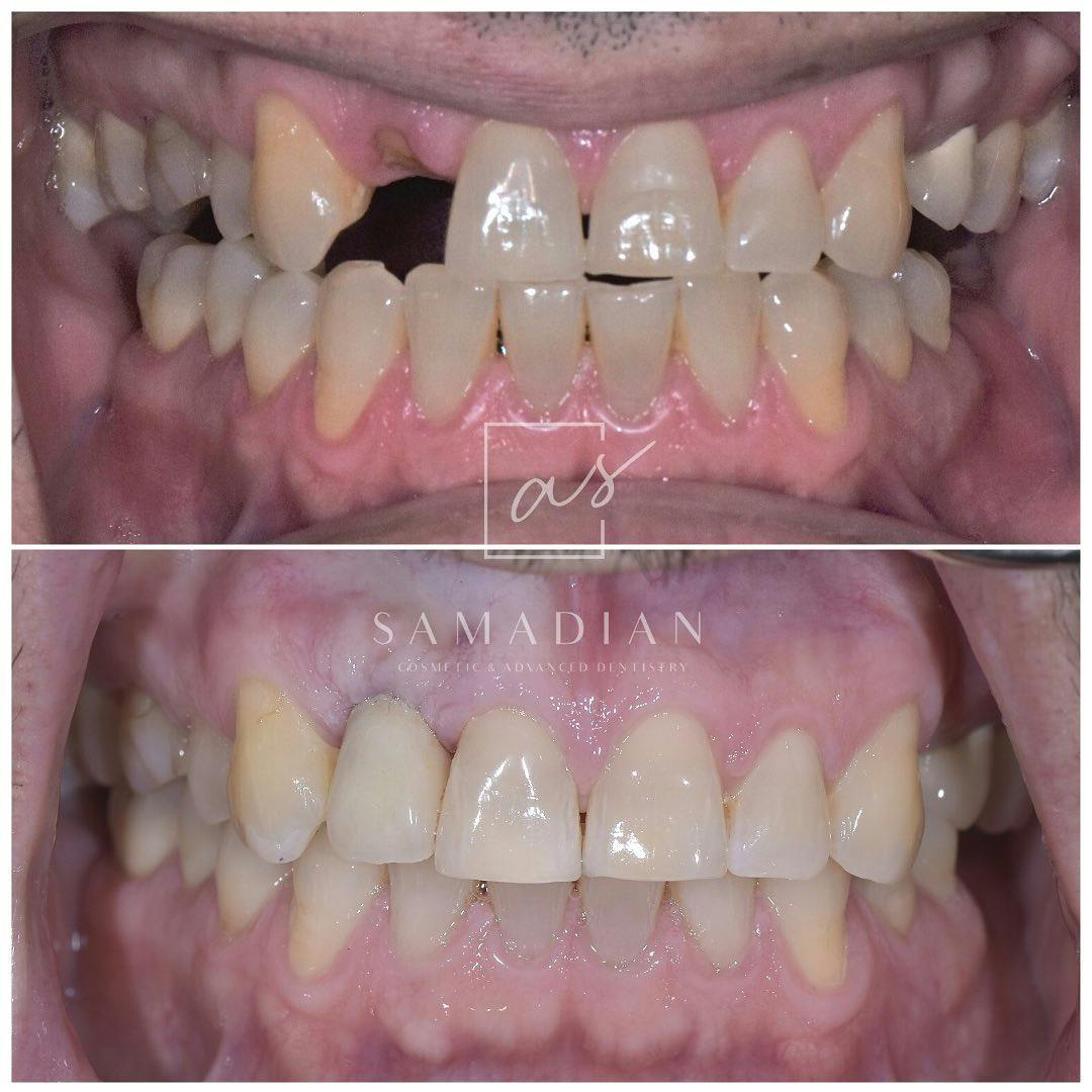 Dental Implants Before & After Gallery - Patient 254037 - Image 3